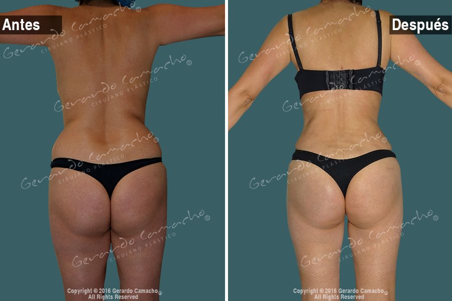 Cambio estético gracias a la abdominoplastia en Bogotá